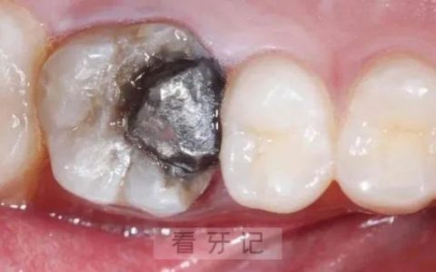 继发龋真实图片！为什么会出现继发龋？