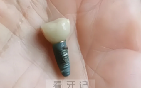 种植牙真实图片分享！看看种植牙牙根到底是长什么样的？
