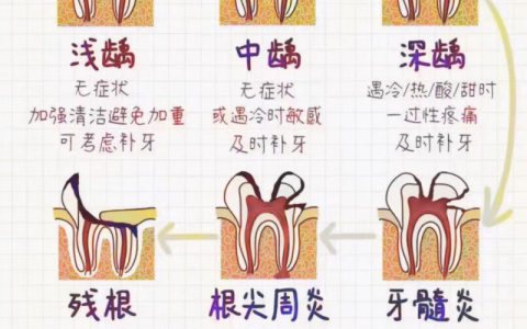 牙齿小黑洞蛀牙严重等级图片