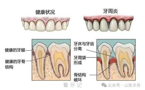 牙周炎的牙和健康的牙区别有哪些？附照片对比图