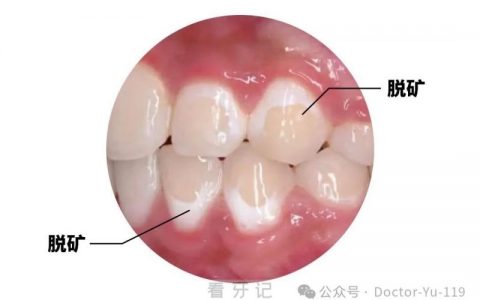 小孩子得了蛀牙有必要去医院治疗吗？有哪些危害？
