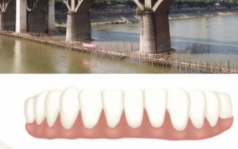 全口种植牙、半口种植牙、ALL-ON-4、ALL-ON-6到底有哪些区别？哪个更好？