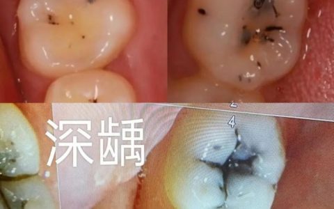什么是龋齿龋病？浅龋深龋真实照片对比图