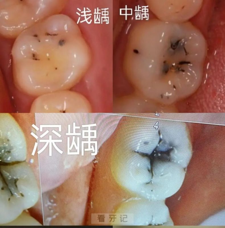 什么是龋齿龋病？浅龋深龋真实照片对比图