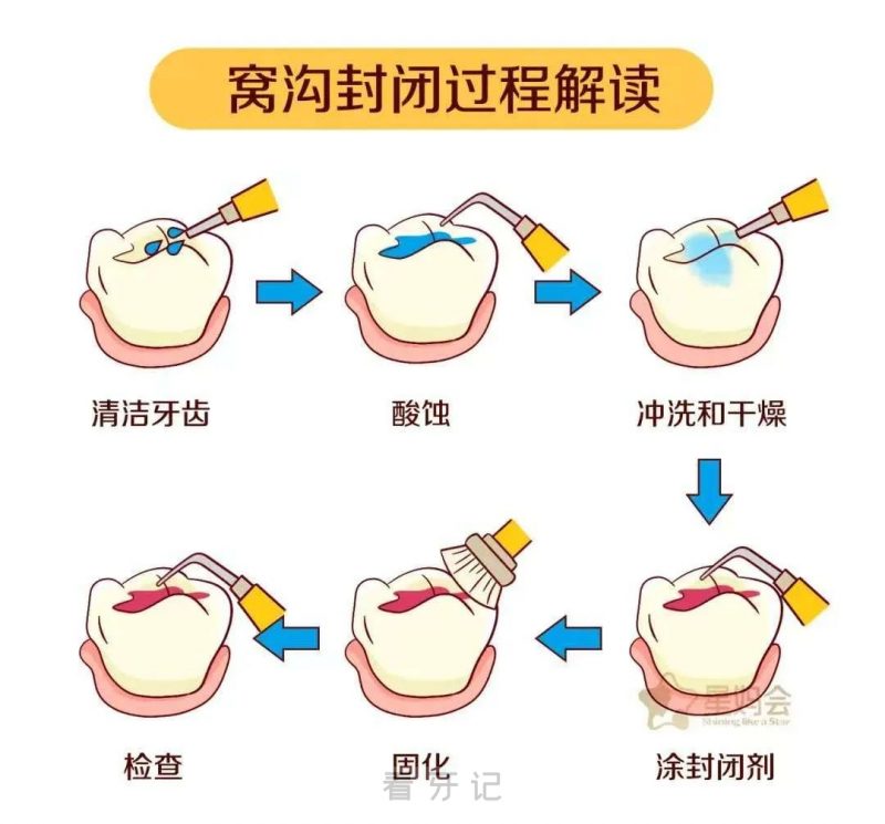 窝沟封闭真实过程示意图