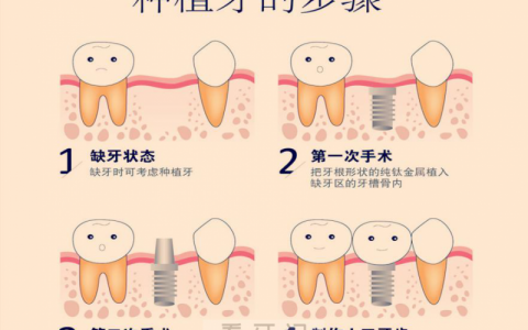 种植牙步骤示意图