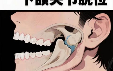 什么是急性颞下颌关节脱位？出现颞下颌关节脱位怎么办？