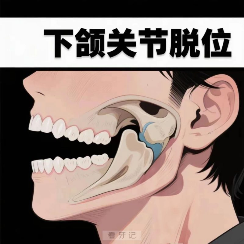 什么是急性颞下颌关节脱位？出现颞下颌关节脱位怎么办？