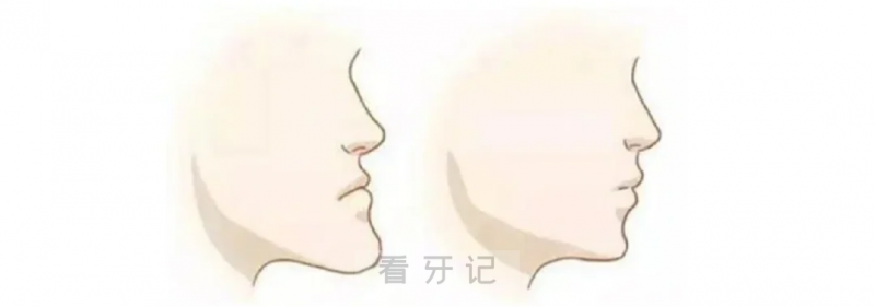 成年人还可以正畸吗？为什么很多良心医生不建议成年人做正畸？