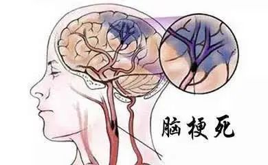 老年人千万不要拔牙！80岁老太拔完牙突发脑梗案例来了