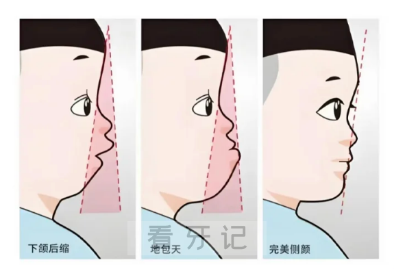 牙齿矫正指南完整版！正畸多少钱？金属、陶瓷、隐形、舌侧优缺点是什么？怎么选合适牙套？（附2025年牙套价格表）