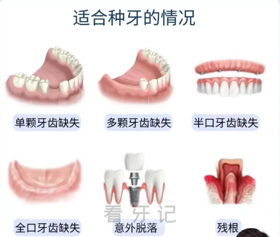 网友爆料种牙被骗 3 万！！种牙前一定要知道这些坑！这几类人根本不能种牙，附2025年各品牌种植牙价格表