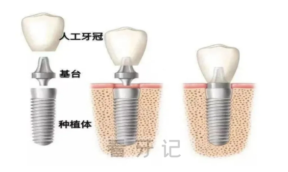 新手种牙攻略！2万一颗的种植牙和2千一颗的区别在哪里，别再乱花冤枉钱！集采后种一颗牙多少钱？附2025种植牙、牙冠集采价格表