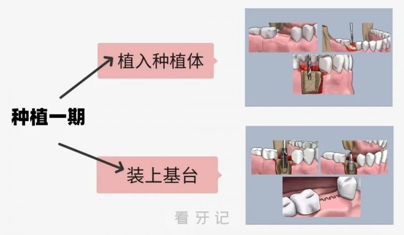 种牙等于浪费钱！良心牙医揭秘种植牙失败率最高的三大人群！快来看看你是不是在里面？