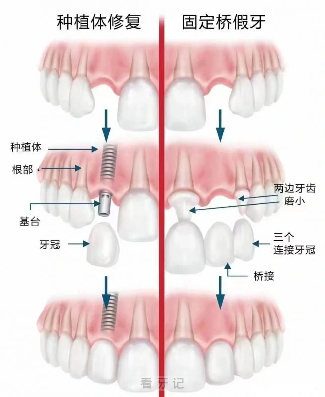 种植牙深度揭秘！图解种植牙凭什么成为缺牙首选？种植牙多少钱一颗？种植牙的使用寿命有多久？种植牙的过程？种植牙的8个后遗症？