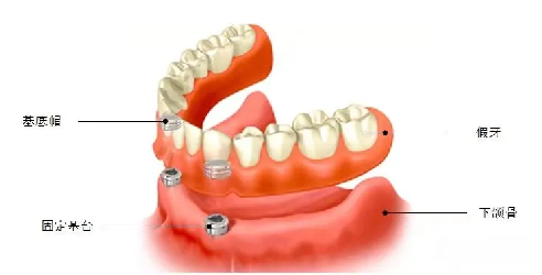 什么是LOCATOR？LOCATOR修复义齿怎么样？靠谱吗？优缺点有哪些？