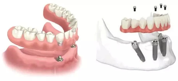什么是LOCATOR？LOCATOR修复义齿怎么样？靠谱吗？优缺点有哪些？