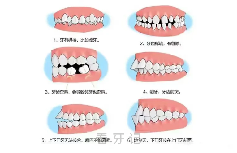 正畸最低多少钱？5000块够吗？2025牙齿矫正价格表来了！普通家庭也做得起正畸！牙套选择？金属、陶瓷、隐形，附牙齿矫正最佳年龄、注意事项！
