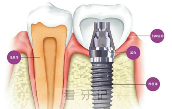 种植牙贵的和便宜的到底有什么区别？如何选择适合自己的种植体和医生？2025最新价格表+医生医院避坑指南！今天一次性讲清楚！