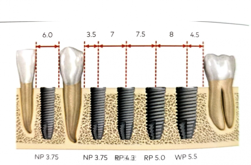 良心牙医忠告：种植牙选国产还是进口？可以用国产的种植体吗？国外的种植体到底都贵哪儿了？