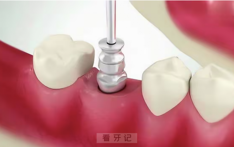 良心牙医整理出的种植牙十大热门问题！成功率、疼不疼、材料、过程、寿命、价格、风险…每一条都值得收藏！