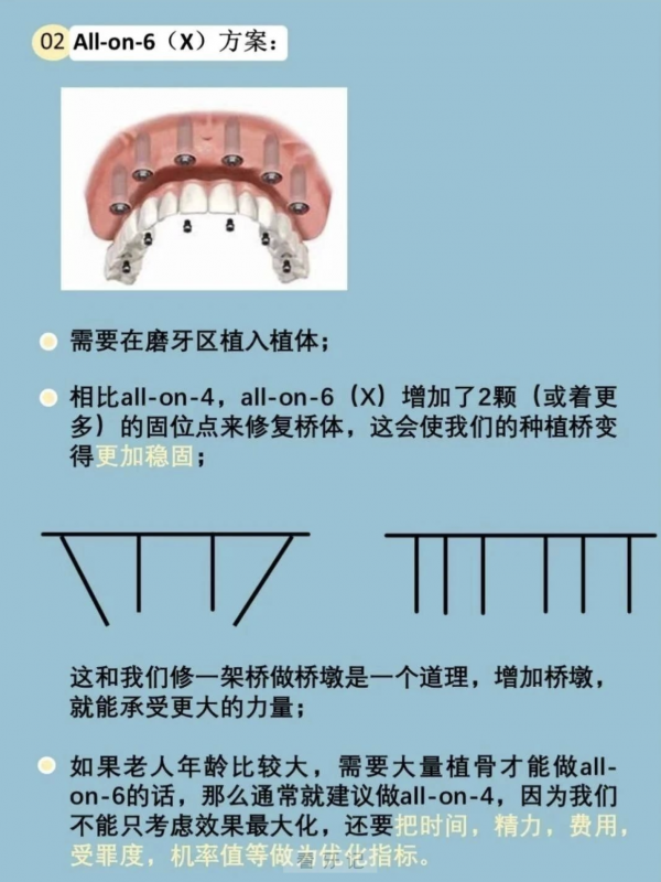 四张图片请收藏！半口全口种植为什么选择all-on-4和all-on-6方案？全网最全分析图文攻略