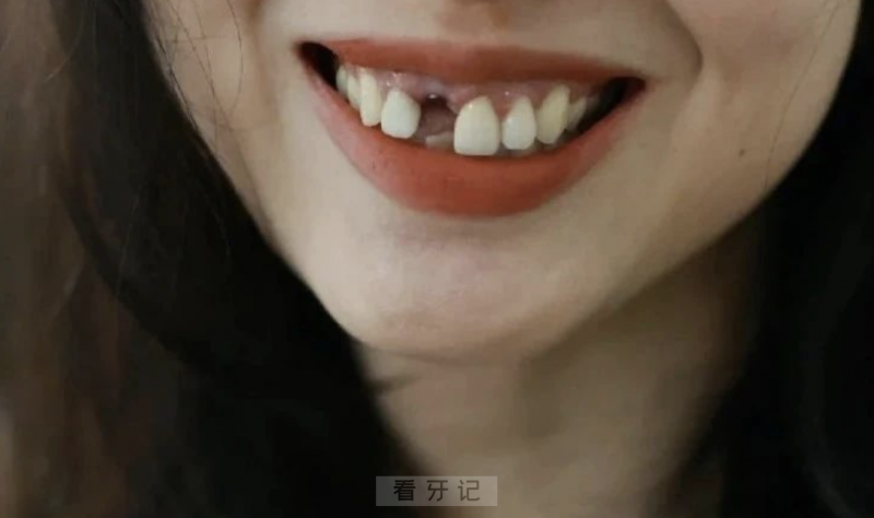 干口腔十年听我一句劝，年轻人缺牙尽量别拖！25 岁种牙和 40 岁种牙，差距远远不止是钱。最全的种植牙良心忠告建议来了