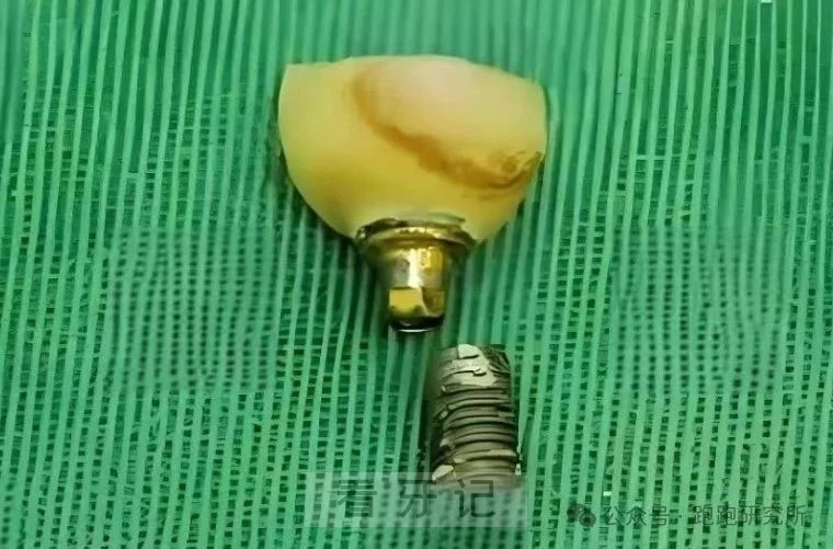 种植体价格跌破1000？集采后韩国进口种植体只要770元/颗？是真的！但种植牙全包价低于4000元需警惕二手翻新假货