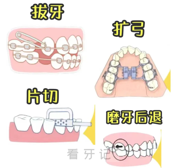 正畸攻略儿童版来了→孩子12岁换完牙才能矫正？家长必看！儿童正畸黄金年龄是几岁？儿童正畸一般多少钱？需要多长时间？附牙齿矫正价格