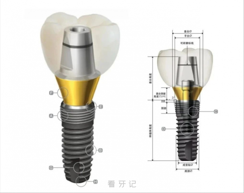 别再纠结种植牙品牌了！！种植牙选产地不如看适配度！进口、国产各有侧重，不适合你的植体再贵也没有用！
