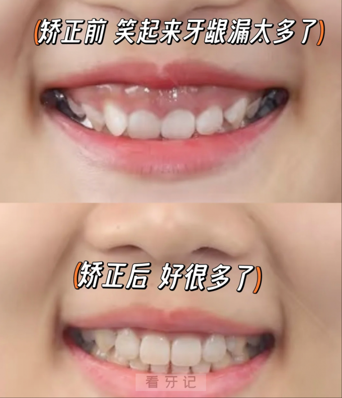 种植牙后矫正能否继续做？牙齿种植正畸有哪些风险！种植牙、牙齿矫正90%的人不知道的真相，附种植牙、牙齿矫正价格表分享！