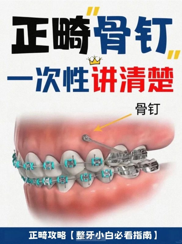 正畸骨钉科普攻略！为什么牙齿矫正要打骨钉？让人“闻风丧胆”的骨钉，要哪些情况才会打？到底疼不疼？