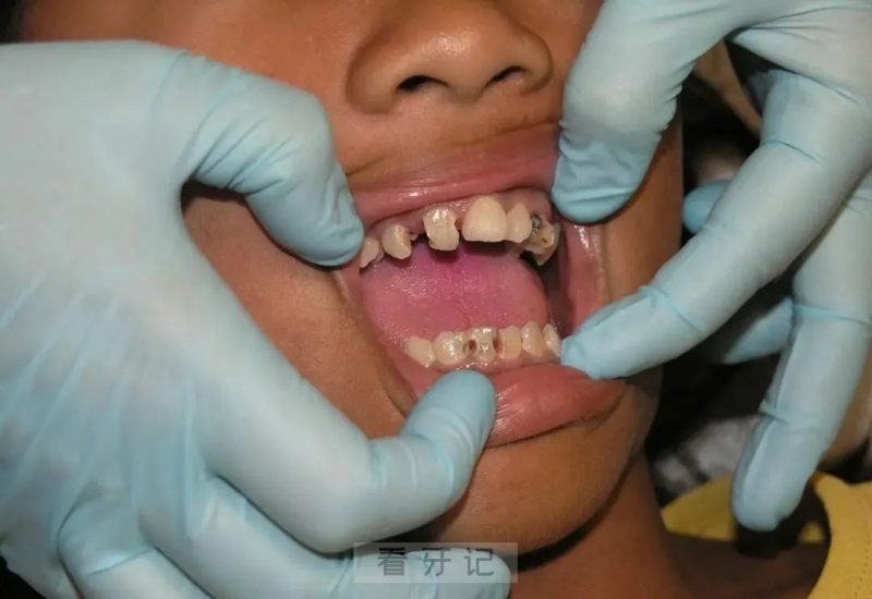 太可怕了！王大爷牙痛拔牙心切！向医生隐瞒心脏病史，拔牙后诱发心绞痛和短暂脑循环障碍，差点丧命