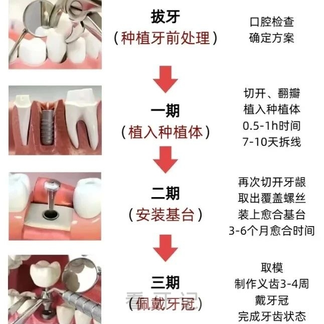 当天拔牙当天种牙当天啃骨头？都是骗人的！良心牙医告诉你种一颗牙要多久？