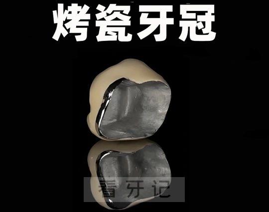 牙冠攻略指南！牙冠多少钱一颗？金属/烤瓷牙冠哪个好？优缺点有哪些？使用寿命是多久？附2025最新牙冠价格表+口腔医院医生推荐！