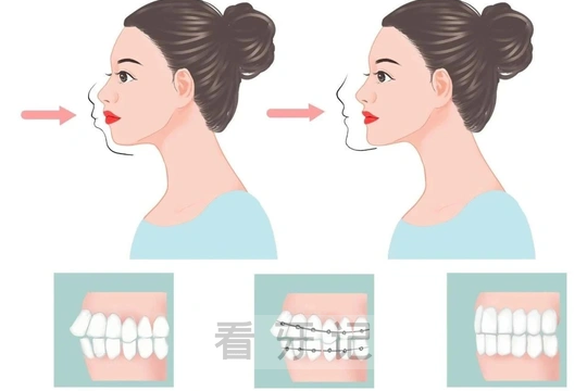 牙齿矫正攻略来了！哪些情况需要正畸？金属、隐形、陶瓷牙套怎么选？牙齿矫正黄金期+流程解析，看完让你少走弯路！附2025牙齿矫正最新价格表