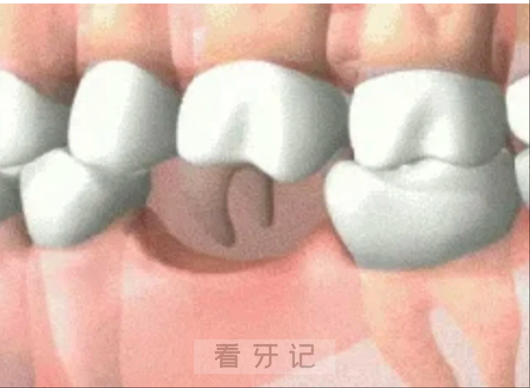 口腔行业摸爬滚打近二十年含泪分享最新种牙攻略！种牙像买房？错！拖到骨萎缩，你连“牙学区”资格都没了