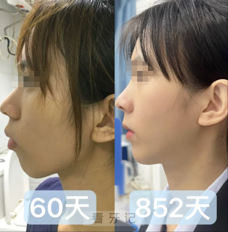 正畸攻略！牙齿矫正有后遗症吗？正畸五大风险如何避免？一文讲清正畸的注意事项，金属、隐形、舌侧哪种牙套好？口腔医院、医生如何选？整牙前必看！