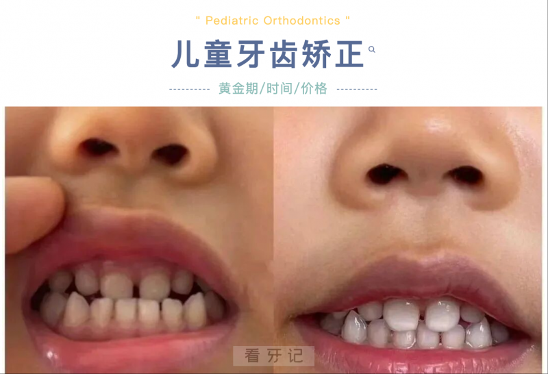 儿童正畸攻略→孩子12岁换完牙才能正畸？一文讲清正畸最佳年龄？牙齿矫正一般多少钱？需要多长时间？附牙齿矫正价格，别等孩子换完牙才矫正