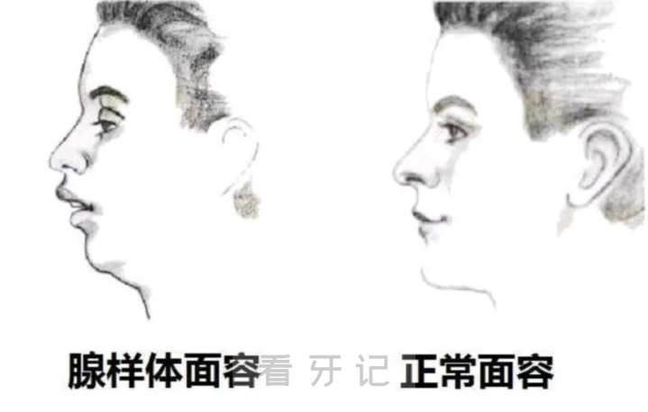 口呼吸腺样体肥大真实图片对比图