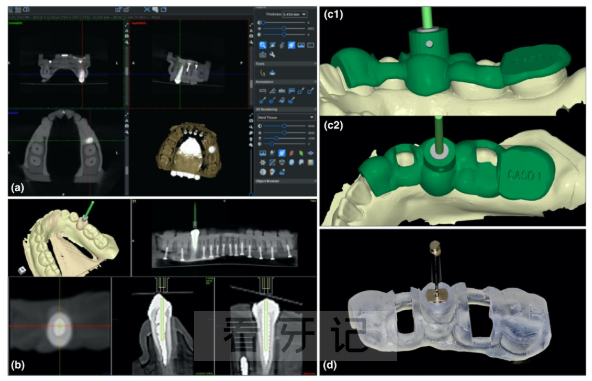 传统种植牙和数字种植牙有什么区别？哪个风险大？哪个价格贵？最新攻略来了