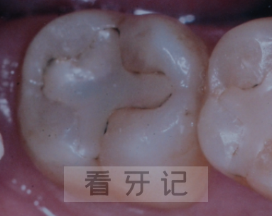 补牙攻略来了！为什么补过的牙又蛀了！算不算医疗事故？可不可以去医院免费补？