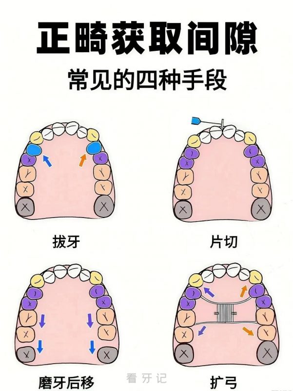 牙齿正畸四大手段整理！想要牙齿排齐又担心拔牙方案有风险怎么办？能不能正畸不拔牙！这四种常见方式你一定要了解！