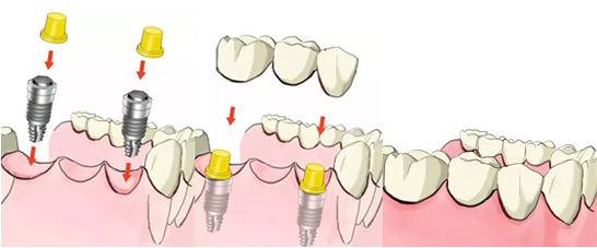 种牙攻略！哪些人不能种牙？哪些人可以当天种牙？2025最常见的五个种植牙热门问题盘点
