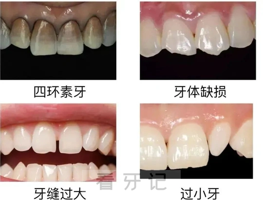 牙贴面攻略！牙缝大/牙缺损能贴牙贴面吗？2025适合人群自测！牙贴面能管几年？牙贴面一般多少钱？不同材料怎么选？附2025牙齿贴面最新价格表