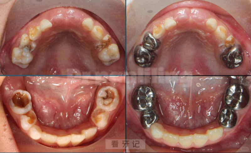蛀牙戴冠攻略！牙疼别再忍了！医生建议你做牙冠？需要做吗？牙冠全面解析攻略：金属冠、烤瓷冠、全瓷冠哪个好？牙冠可以用医保吗？有哪些品牌呢？