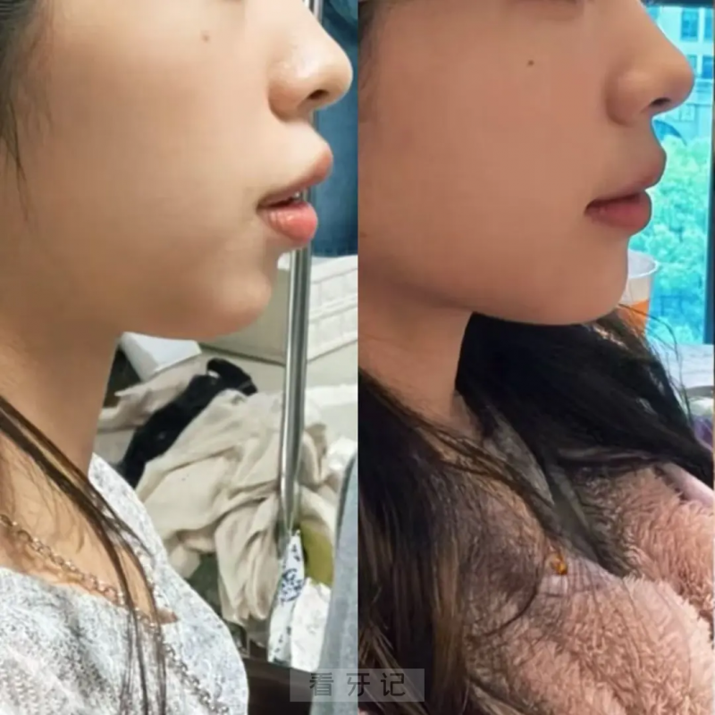 025年9月重庆正畸攻略来了！重庆正畸网友必看！价格从8k到8w，差价十倍到底差在哪？正畸医生怎么选不踩坑？"