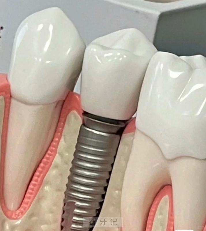 025年9月种牙攻略来了！选三千还是一万的种植牙，两者差在哪？种植牙价格大揭秘！2025种植牙品牌这样选不踩坑！"