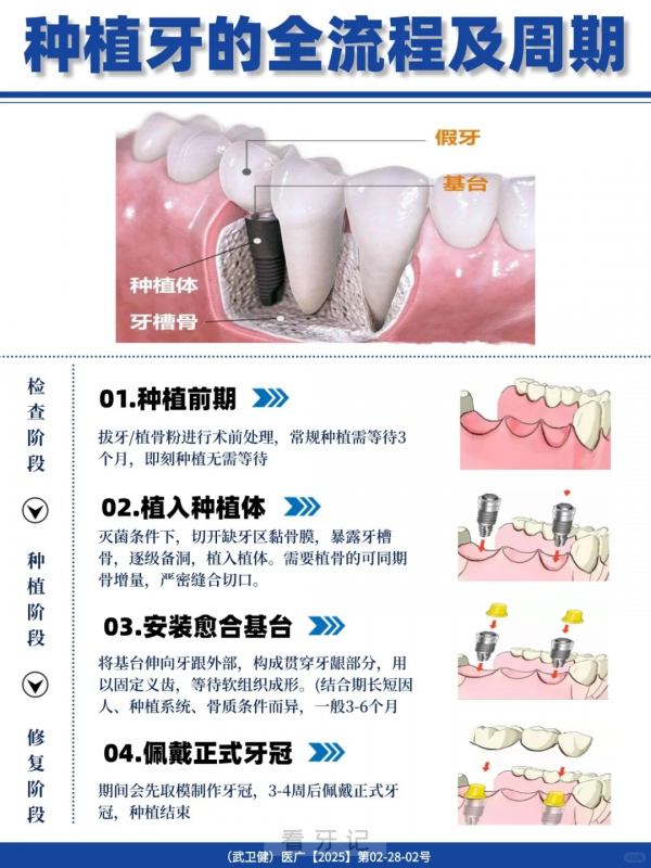 025种植牙最新攻略！如果你不了解这些千万别做种植牙，种植牙多少钱一颗？（附种植牙价格表、口腔医院如何选择、种植体、牙冠选择攻略）"