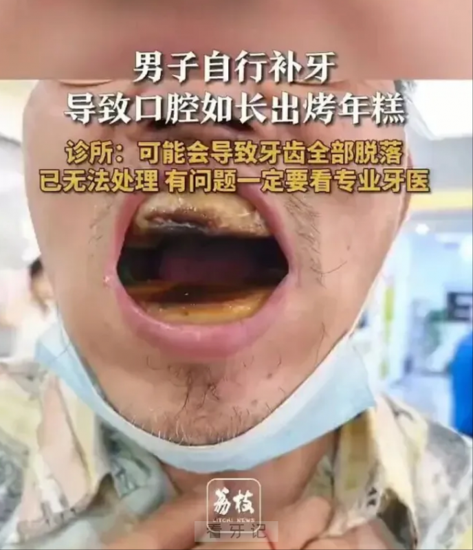 牙医看完吓死了！我不敢拆呐！天津大叔网上花 5 元买材料自行补牙翻车口腔如长出烤年糕